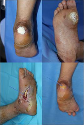 The clinical efficacy of pure-grind acellular dermal matrix without gelatin in lower extremity skin defect treatment: A prospective randomized study